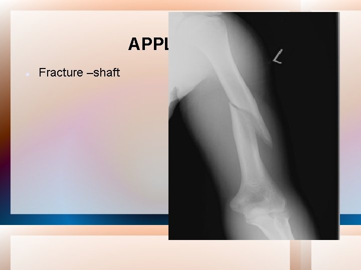 APPLIED Fracture –shaft 
