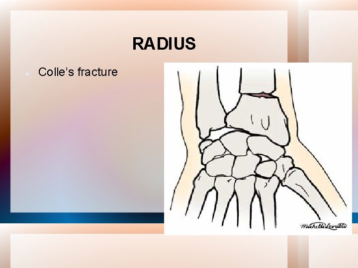 RADIUS Colle’s fracture 