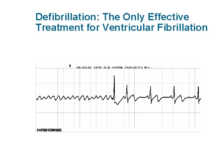 Defibrillation: The Only Effective Treatment for Ventricular Fibrillation 300 JOULES DEFIB 20: 29 01