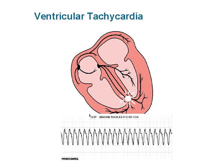 Ventricular Tachycardia 12: 57 29 MAR 96 PADDLES X 1. 0 HR = 214