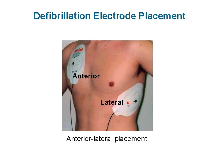 Defibrillation Electrode Placement Anterior Lateral Anterior-lateral placement 