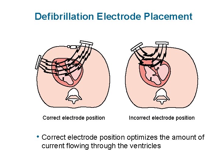 Defibrillation Electrode Placement Correct electrode position Incorrect electrode position • Correct electrode position optimizes