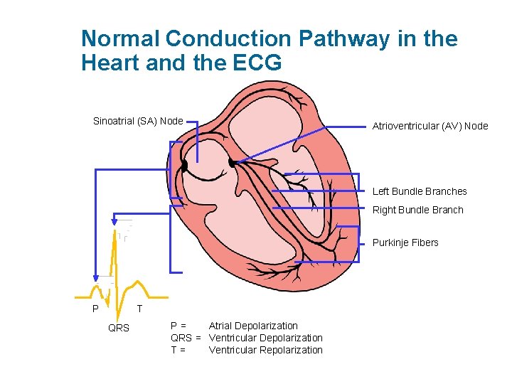 Normal Conduction Pathway in the Heart and the ECG Sinoatrial (SA) Node Atrioventricular (AV)