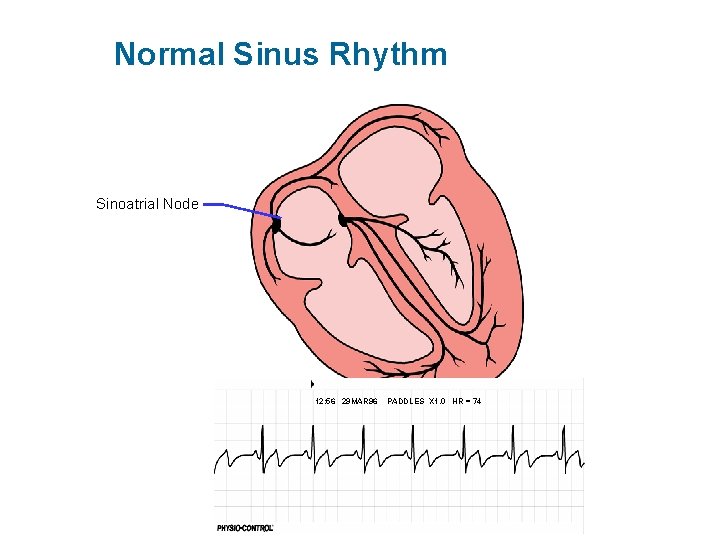 Normal Sinus Rhythm Sinoatrial Node 12: 56 29 MAR 96 PADDLES X 1. 0