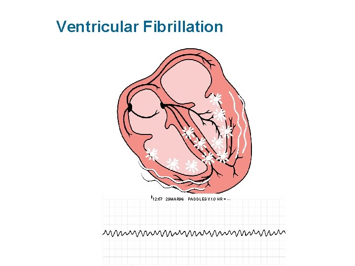 Ventricular Fibrillation 12: 57 29 MAR 96 PADDLES X 1. 0 HR = ---