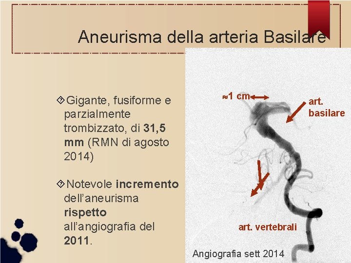 Aneurisma della arteria Basilare Gigante, fusiforme e parzialmente trombizzato, di 31, 5 mm (RMN