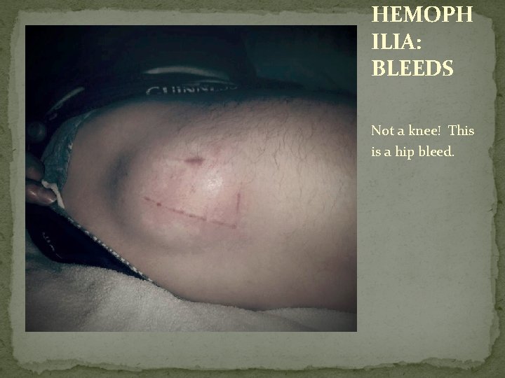 HEMOPH ILIA: BLEEDS Not a knee! This is a hip bleed. 