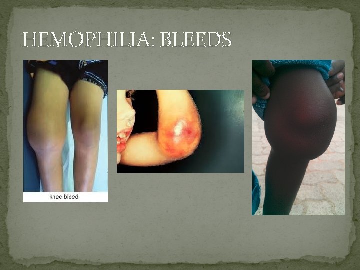 HEMOPHILIA: BLEEDS 