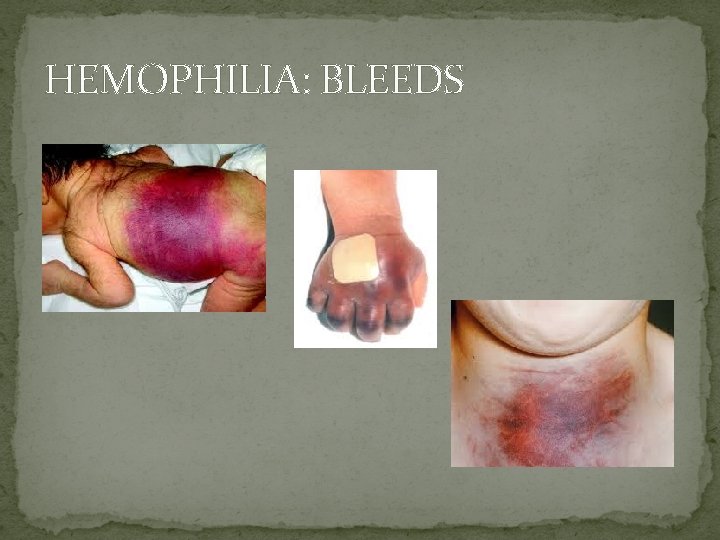 HEMOPHILIA: BLEEDS 