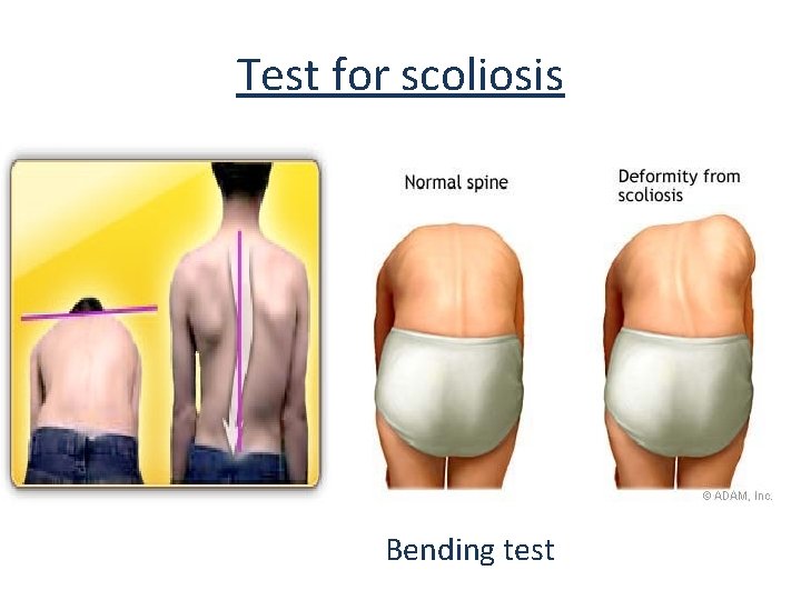 Test for scoliosis Bending test 