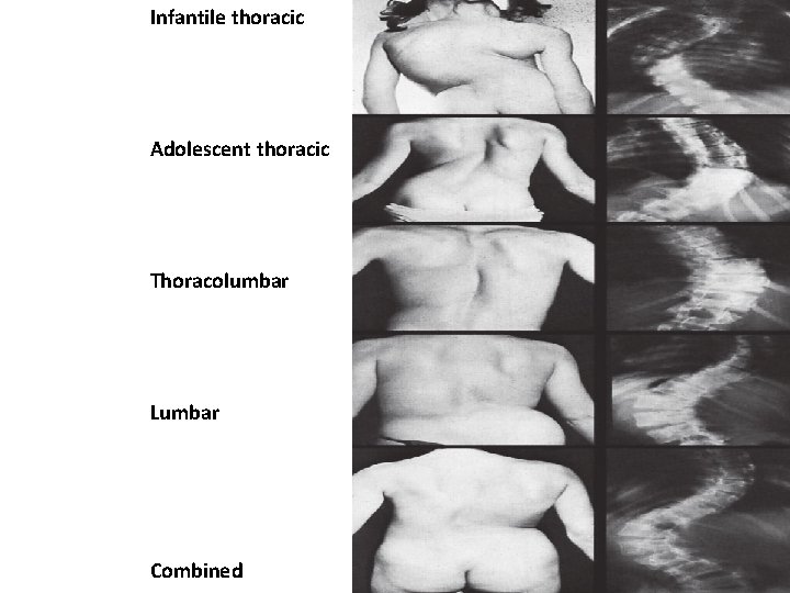 Infantile thoracic Adolescent thoracic Thoracolumbar Lumbar Combined 
