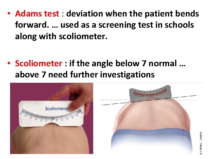  • Adams test : deviation when the patient bends forward. … used as