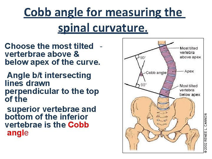 Cobb angle for measuring the spinal curvature. Choose the most tilted verterbrae above &