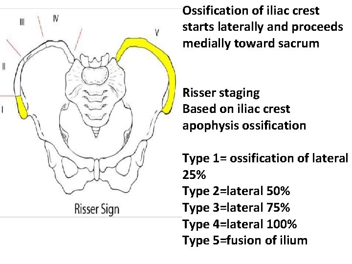 Ossification of iliac crest starts laterally and proceeds medially toward sacrum Risser staging Based