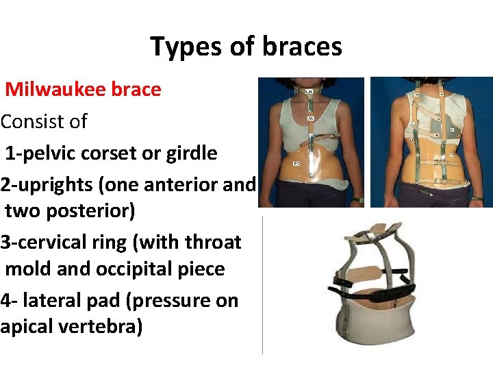 Types of braces Milwaukee brace Consist of 1 -pelvic corset or girdle 2 -uprights