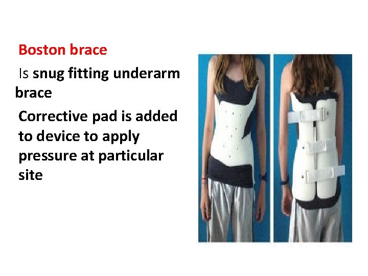 Boston brace Is snug fitting underarm brace Corrective pad is added to device to
