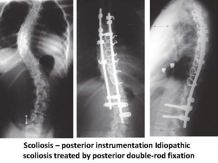 Scoliosis – posterior instrumentation Idiopathic scoliosis treated by posterior double-rod fixation 