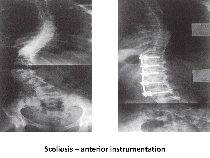 Scoliosis – anterior instrumentation 