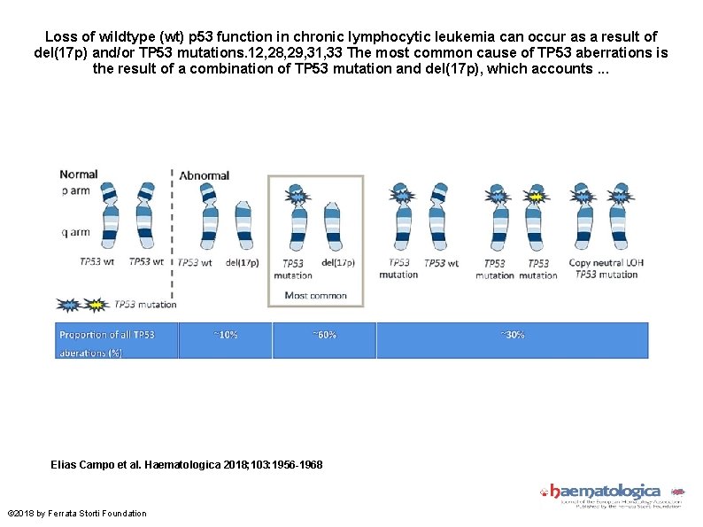 Loss of wildtype (wt) p 53 function in chronic lymphocytic leukemia can occur as
