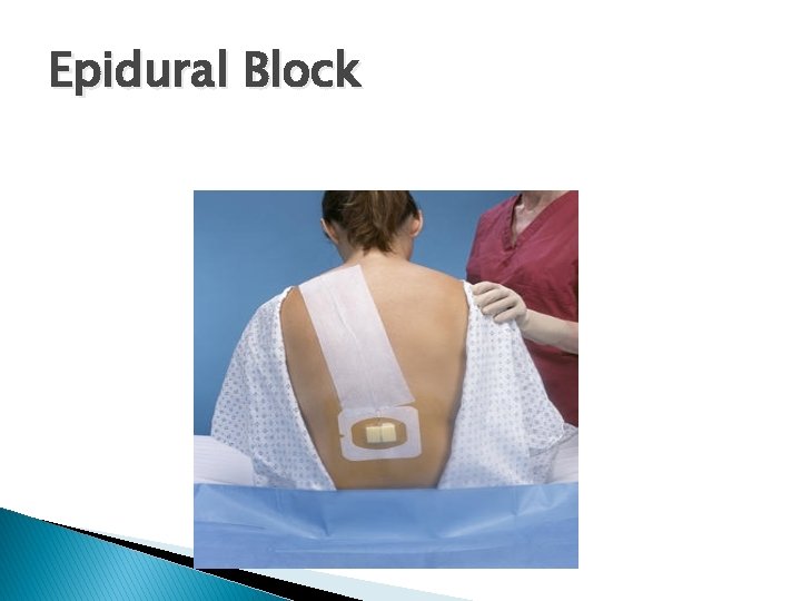 Epidural Block 