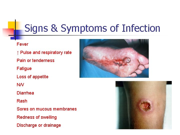 Signs & Symptoms of Infection Fever ↑ Pulse and respiratory rate Pain or tenderness