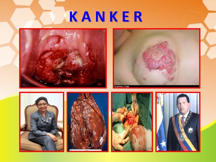 KANKER KANKER