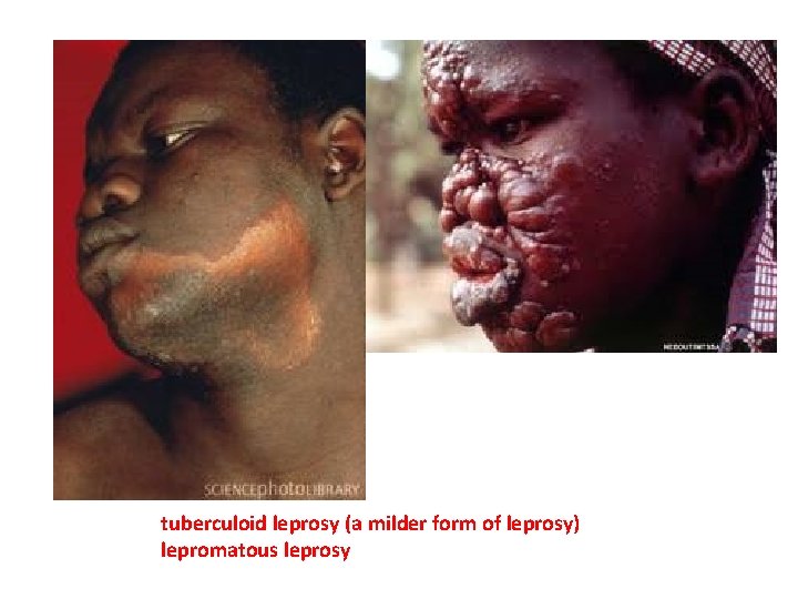 tuberculoid leprosy (a milder form of leprosy) lepromatous leprosy 