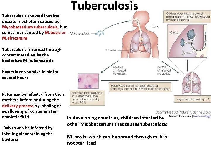 Tuberculosis showed that the disease most often caused by Mycobacterium tuberculosis, but sometimes caused