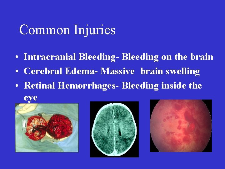 Common Injuries • Intracranial Bleeding- Bleeding on the brain • Cerebral Edema- Massive brain