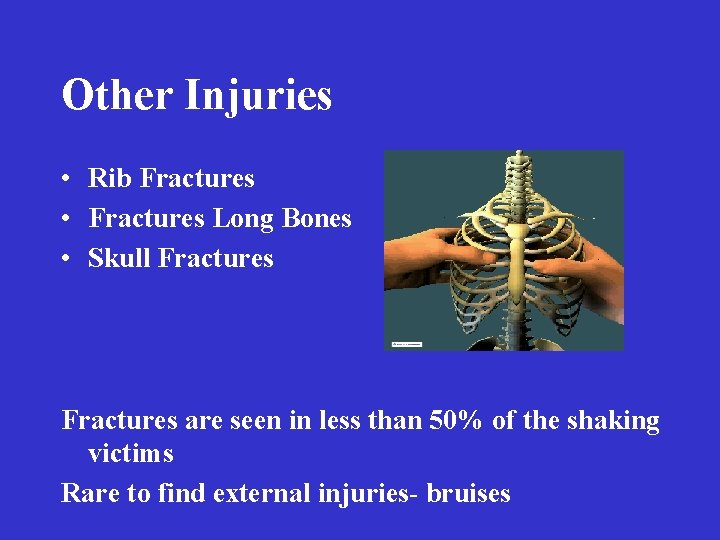 Other Injuries • Rib Fractures • Fractures Long Bones • Skull Fractures are seen