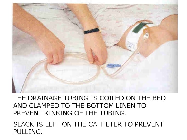 THE DRAINAGE TUBING IS COILED ON THE BED AND CLAMPED TO THE BOTTOM LINEN