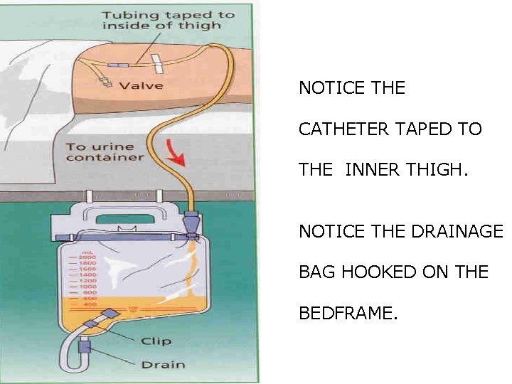 NOTICE THE CATHETER TAPED TO THE INNER THIGH. NOTICE THE DRAINAGE BAG HOOKED ON