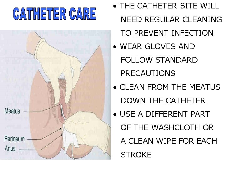  • THE CATHETER SITE WILL NEED REGULAR CLEANING TO PREVENT INFECTION • WEAR