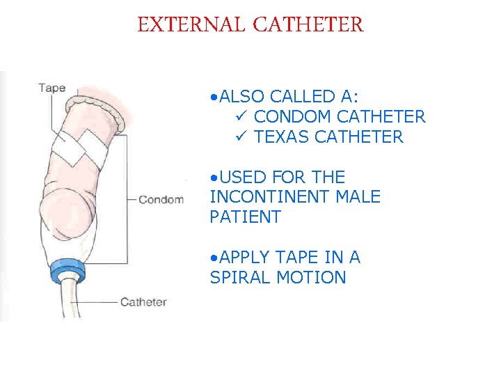 EXTERNAL CATHETER • ALSO CALLED A: ü CONDOM CATHETER ü TEXAS CATHETER • USED