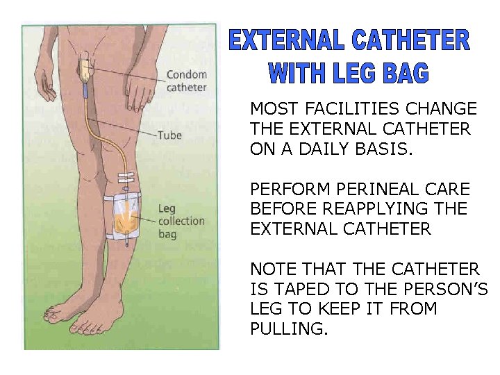 MOST FACILITIES CHANGE THE EXTERNAL CATHETER ON A DAILY BASIS. PERFORM PERINEAL CARE BEFORE
