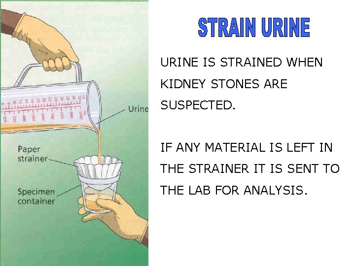 URINE IS STRAINED WHEN KIDNEY STONES ARE SUSPECTED. IF ANY MATERIAL IS LEFT IN