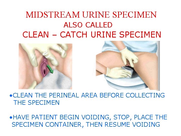 MIDSTREAM URINE SPECIMEN ALSO CALLED CLEAN – CATCH URINE SPECIMEN • CLEAN THE PERINEAL
