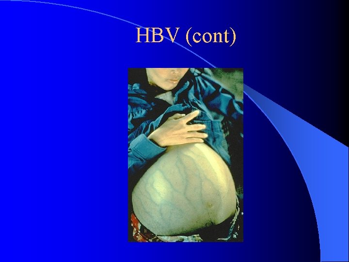 HBV (cont) 