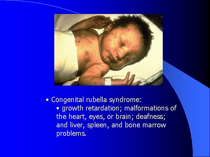  • Congenital rubella syndrome: • growth retardation; malformations of the heart, eyes, or