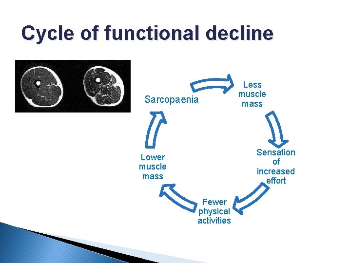 Cycle of functional decline Sarcopaenia Less muscle mass Sensation of increased effort Lower muscle
