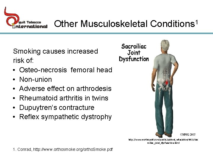 Other Musculoskeletal Conditions 1 Smoking causes increased risk of: • Osteo-necrosis femoral head •
