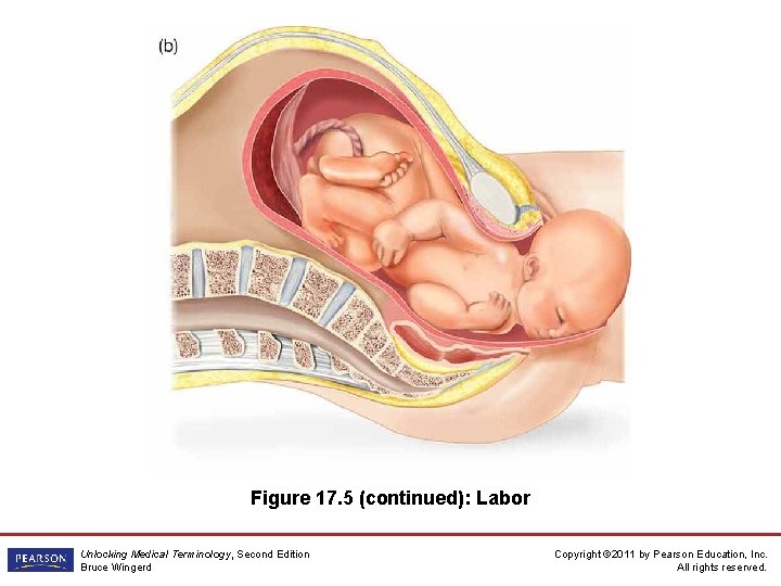 Figure 17. 5 (continued): Labor Unlocking Medical Terminology, Second Edition Bruce Wingerd Copyright ©