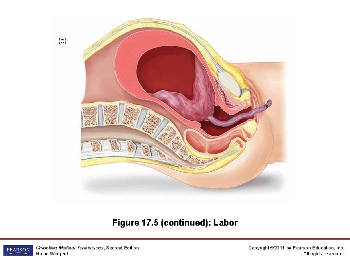 Figure 17. 5 (continued): Labor Unlocking Medical Terminology, Second Edition Bruce Wingerd Copyright ©