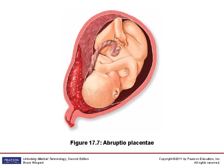 Figure 17. 7: Abruptio placentae Unlocking Medical Terminology, Second Edition Bruce Wingerd Copyright ©