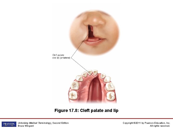 Figure 17. 8: Cleft palate and lip Unlocking Medical Terminology, Second Edition Bruce Wingerd