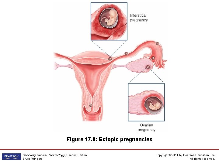 Figure 17. 9: Ectopic pregnancies Unlocking Medical Terminology, Second Edition Bruce Wingerd Copyright ©