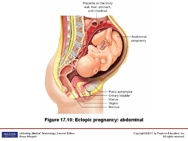 Figure 17. 10: Ectopic pregnancy: abdominal Unlocking Medical Terminology, Second Edition Bruce Wingerd Copyright