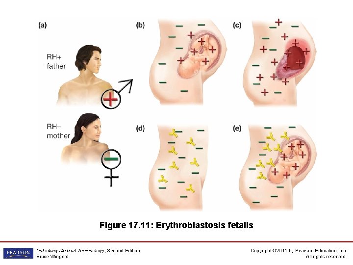 Figure 17. 11: Erythroblastosis fetalis Unlocking Medical Terminology, Second Edition Bruce Wingerd Copyright ©