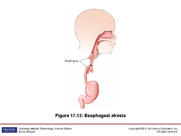 Figure 17. 12: Esophageal atresia Unlocking Medical Terminology, Second Edition Bruce Wingerd Copyright ©