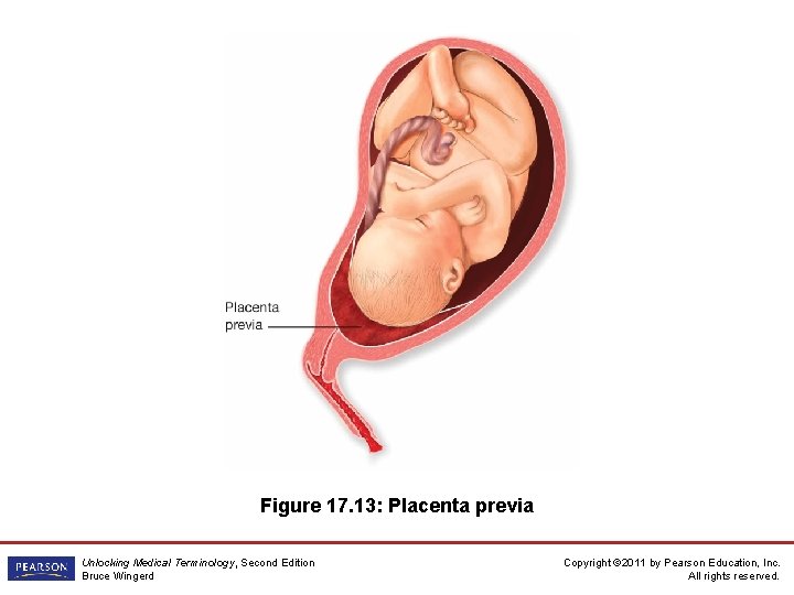 Figure 17. 13: Placenta previa Unlocking Medical Terminology, Second Edition Bruce Wingerd Copyright ©